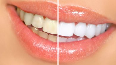 Photo of Explore Everything About Teeth Whitening Using Crest Whitestrips in UK