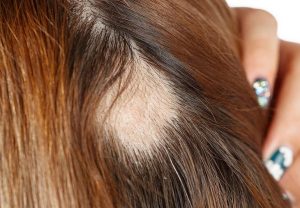 Weaves may result in hair loss