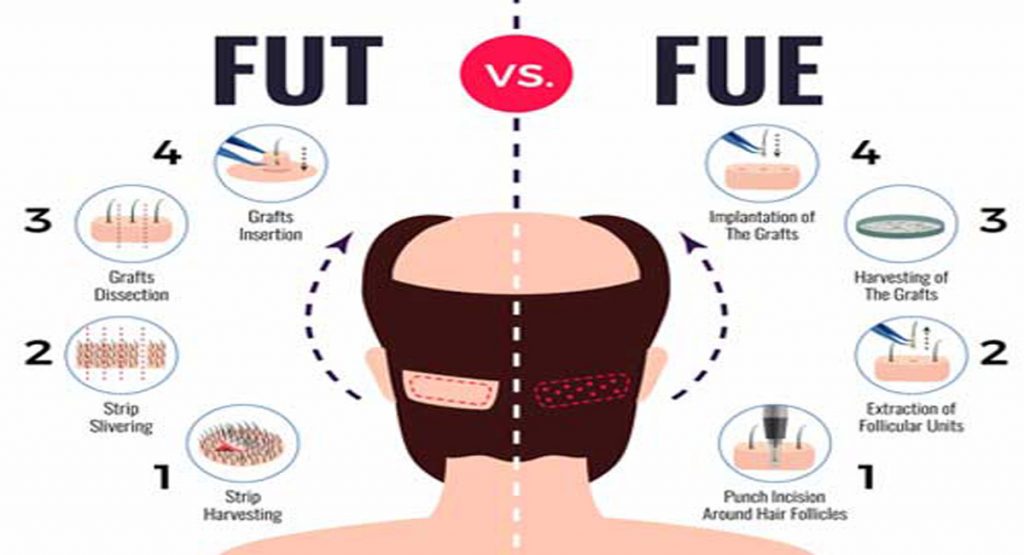 fue vs fut- Main points between FUE and FUT hair transplant