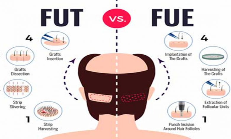 fue vs fut- Main points between FUE and FUT hair transplant
