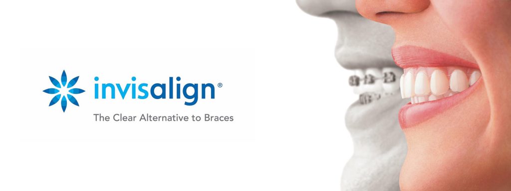 Invisalign