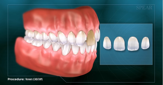 Excellent Guide about Porcelain Veneers to Patients