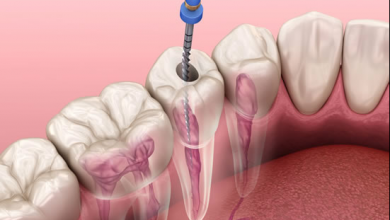 Photo of Dental Root Canal Therapy