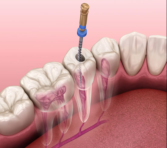 dental root canal therapy