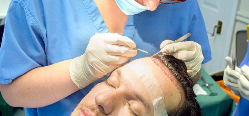 fue hair transplant