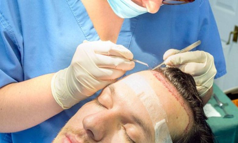 fue hair transplant