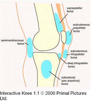 arthritis