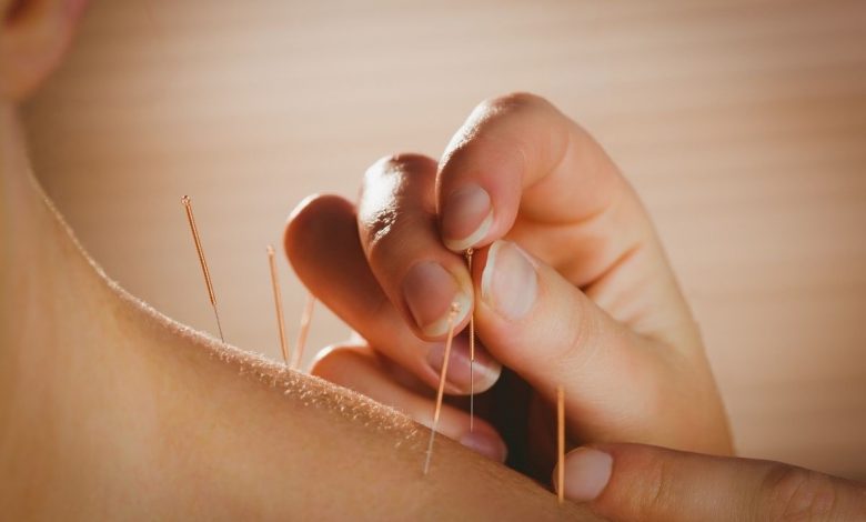 young-women-getting-acupuncture-treatment