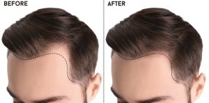 hair transplant