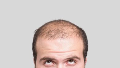 Photo of Male Pattern Baldness