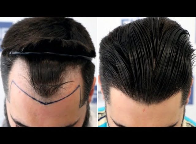 hair transplant