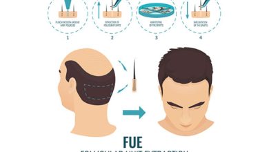 Photo of FUT Hair Transplantation