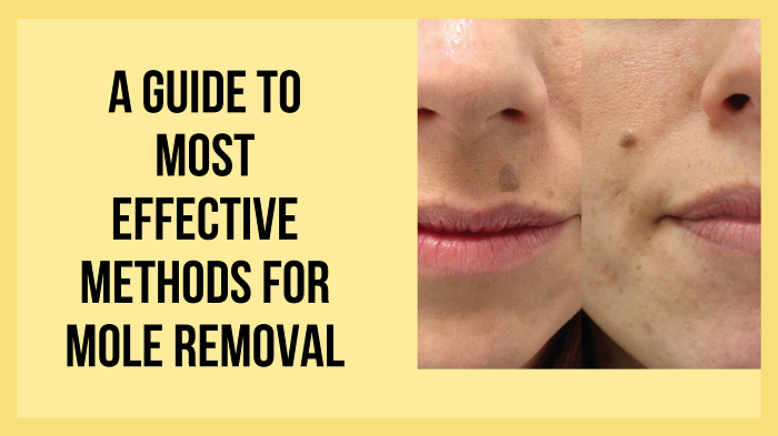 A Guide To Most Effective Methods For Mole Removal