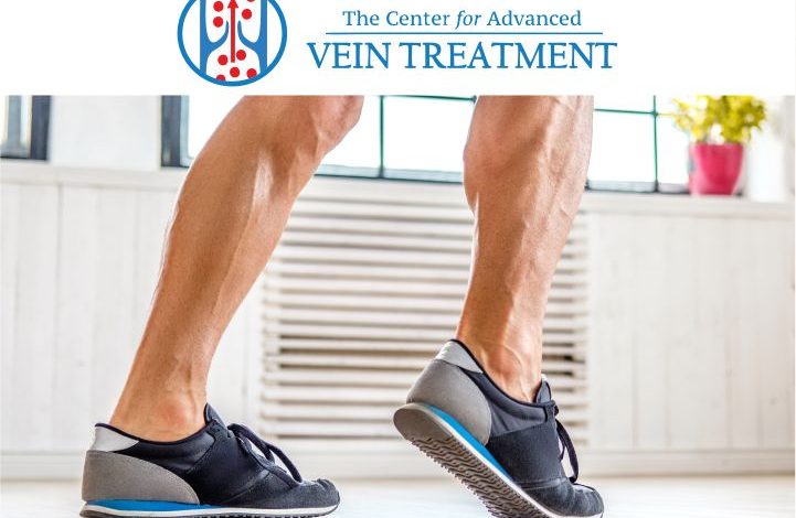 Spider Vein Treatment: What Is It And Why It Is Important?