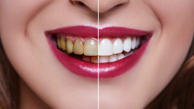 Photo of Dental Veneers: Everything You Need to Know