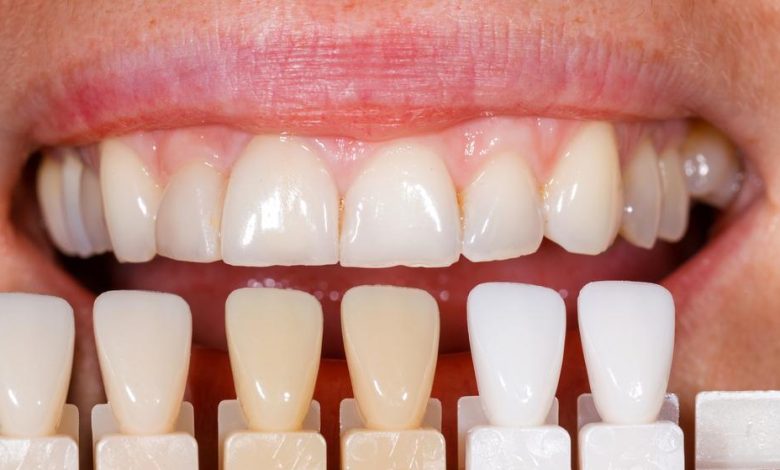 Dental Veneers