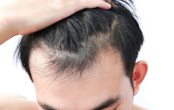 PRP Treatment for Hair Restoration