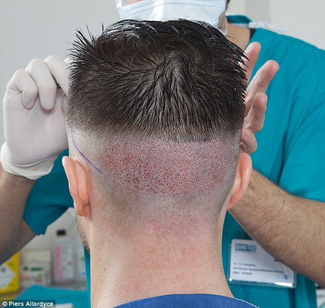 textured hair transplant