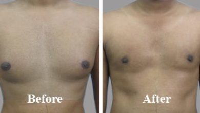 Photo of How does Gynecomastia surgery helps to get rid of this problem?