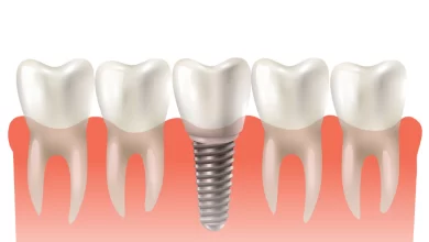 Photo of All you need to Know about Dental Implants