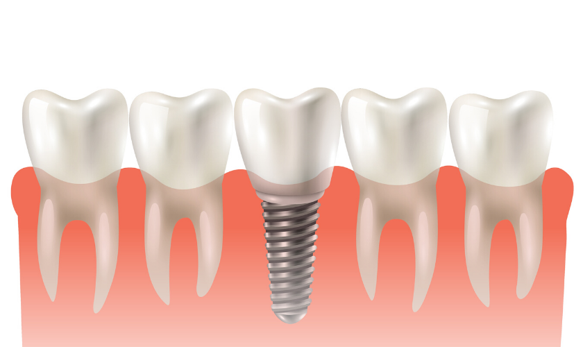 dental implants