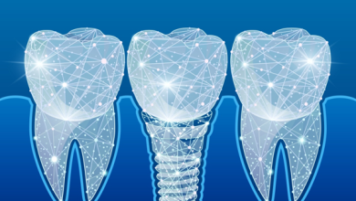 Photo of 9 Counterintuitive Tips for Crushing Your Dental Implants Goals