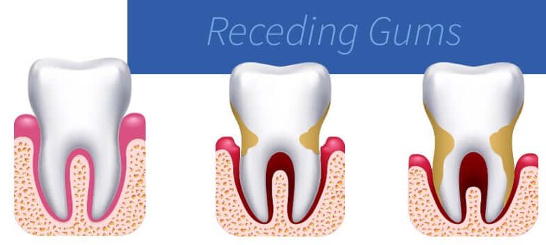 Restore Receding Gums