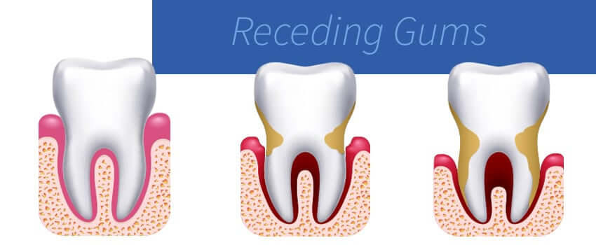 Restore Receding Gums