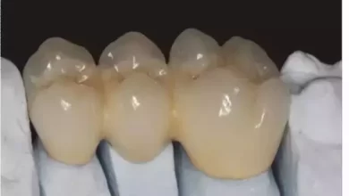 Photo of Can I Chew Gum with Zirconia Crowns?