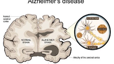 Photo of Understanding Alzheimer’s Disease: Modern Approaches to Diagnosis, Treatment, and Prevention