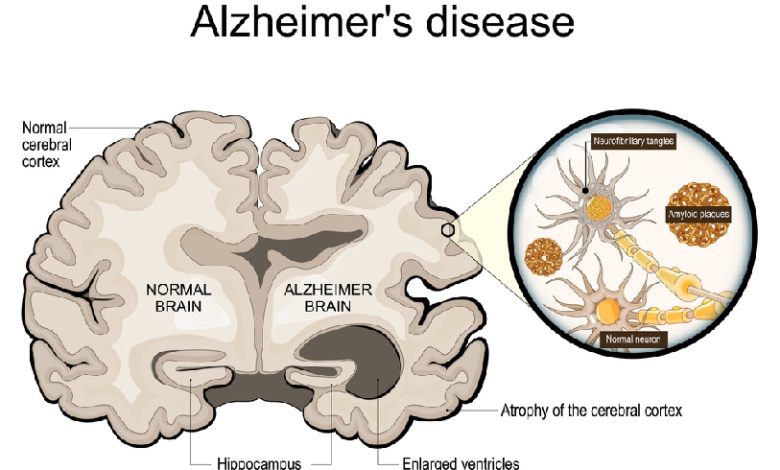 Alzheimer's Disease