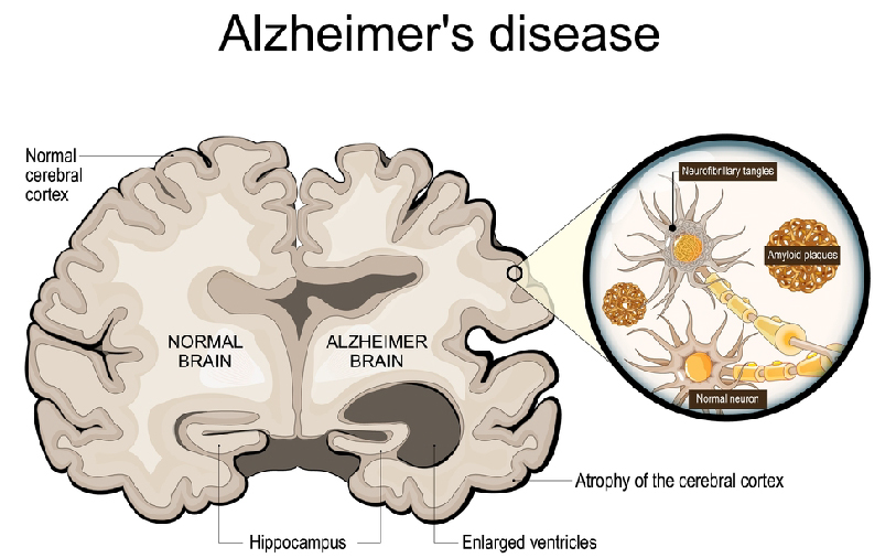 Alzheimer's Disease